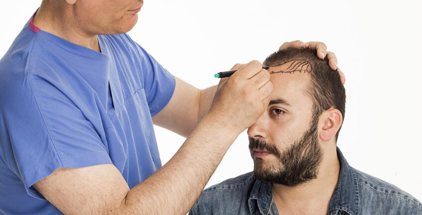 Facts and Myths of Hair Transplant Surgery – Indian Association Of  Aesthetic Plastic Surgeons