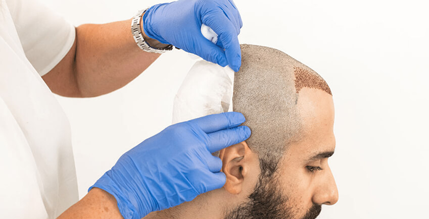 The dark side of hair transplant surgery- how can you stay safe? – Indian  Association Of Aesthetic Plastic Surgeons