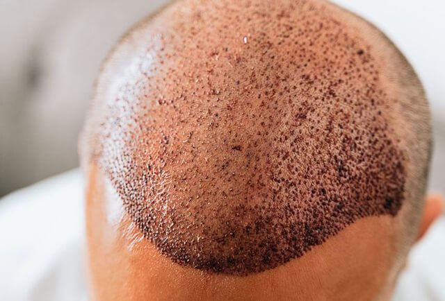 Safety Consideration in Hair Transplant