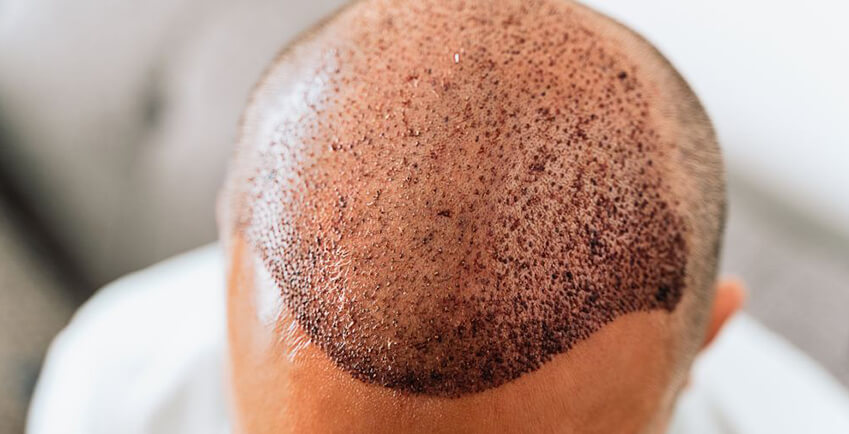 Safety Consideration in Hair Transplant